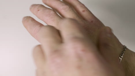 Person-With-Hand-Disease-Scratching---Health-Problems-With-Skin---Close-Up-Shot