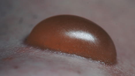 Closeup-Of-Extreme-Painful-Blister-Infected-With-Pus,-Medical-Treatment-And-Dermatologist-Patient