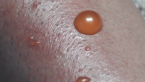 Closeup-Of-Redness-And-Painful-Sports-Surrounding-Fluid-Filled-Blisters-On-Human-Skin