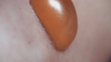Closeup-Shot-Of-A-Fluid-Filled-Blister-On-Human-Skin,-Swollen,-Painful-And-Irritated