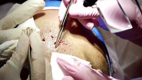 Close-up-of-individually-harvested-hair-follicles-from-patient's-beard-during-FUE-transplantation-procedure
