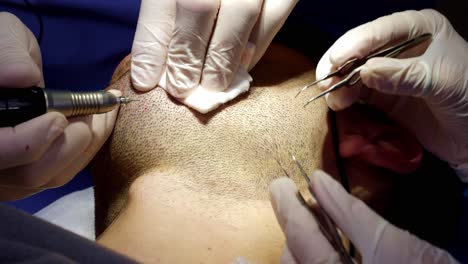 Doctors-harvesting-beard-follicles-for-hair-transplant-in-regeneration-clinic