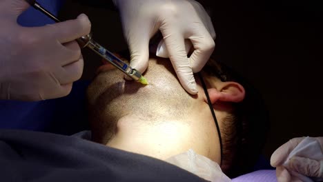 Paciente-Preparándose-Para-El-Trasplante-De-Cosecha-De-Barba-Con-Inyección-Anestésica-Subcutánea
