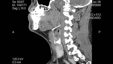 Sagittalebenen-Tomographie:-CT-Scan-Schichten-Des-Unteren-Gesichts-Und-Des-Halses