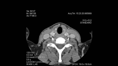 Axiale-Tomographie:-CT-Scan-Schichten-Von-Der-Oberseite-Des-Kopfes-Bis-Zur-Mitte-Des-Brustkorbs