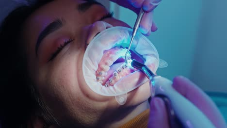 Kieferorthopäde-Befestigt-Zahnspangen-Durch-Lichthärtung-An-Den-Zähnen,-Zahnheilkunde