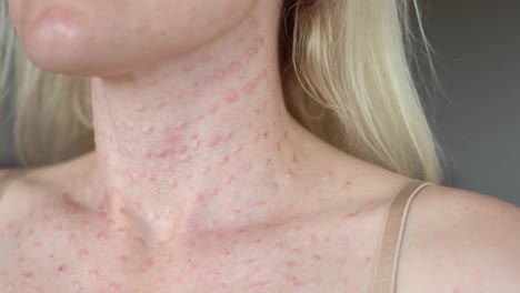 Real-skin-Biorevitalization-on-white-background.-Traces-of-biorevitalization-injections-on-woman-face.-Biorevitalization-needle-marks-Beauty-treatment-real-papules-after-hyaluronic-injection-Close-up.