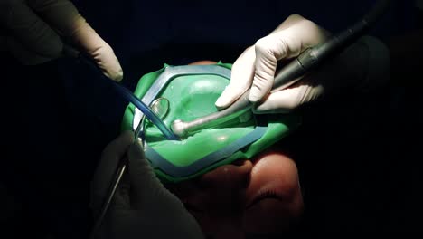 Arzt-Verwendet-Zahnärztliches-Handstück,-Während-Er-Zahn-Mit-Karies-Behandelt