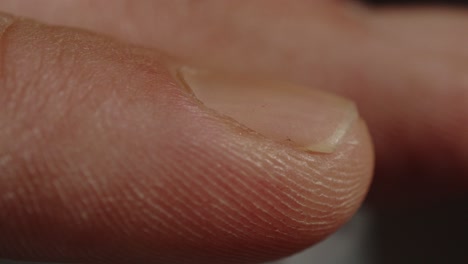Makro-Nahaufnahme-Eines-Verfärbten-Fingernagels-Eines-Mannes-Am-Zeigefinger