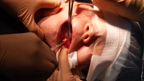 Bichektomie,-Plastische-Chirurgie-Zur-Verengung-Des-Mittleren-Bis-Unteren-Teils-Des-Gesichts,-Extraktion-Von-Wangenfett,-Krankenhaus