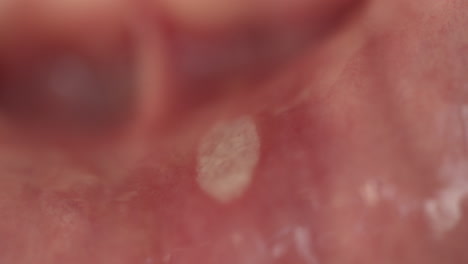 Extreme-Makroaufnahme-Einer-Aphthösen-Stomatitis-Oder-Eines-Krebsgeschwürs-Im-Mund-Eines-Jungen-Mannes