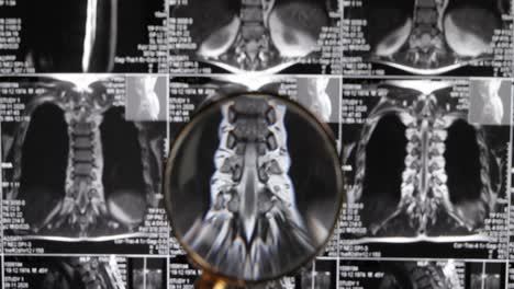 MRI-lumbar-spine-background,-magnetic-resonance-tomography.-Doctor-examines-MRI-of-lumbar-spine-with-pinched-discs-of-spine-and-nerves.