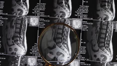 MRI-lumbar-spine-background,-magnetic-resonance-tomography.-Doctor-examines-MRI-of-lumbar-spine-with-pinched-discs-of-spine-and-nerves.