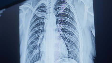 Chest-X-ray-On-Digital-Screen.-closeup