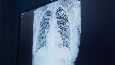 Chest-Xray-Result-Displayed-On-Screen.-closeup