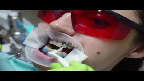 Young-woman-with-an-expander-in-mouth-at-the-dental-clinic.-Application-of-protective-whitening-gel-to-the-teeth.-Modern-dental-office.-Shot-in-4k