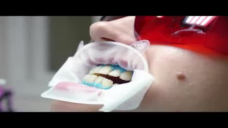 Young-woman-with-an-expander-in-mouth-at-the-dental-clinic.-Application-of-protective-whitening-gel-to-the-teeth.-Modern-dental-office.-Shot-in-4k