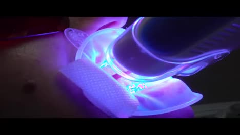UV-Whitening-Teeth---An-ultra-violet-whitening-machine-closeup-in-operation-on-a-patient's-teeth.-Shot-in-4k