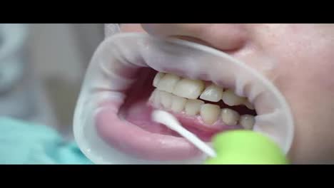 Removing-of-protective-whitening-gel-from-the-teeth.-Young-woman-with-an-expander-in-mouth-at-the-dental-clinic.-Modern-dental-office.-Shot-in-4k