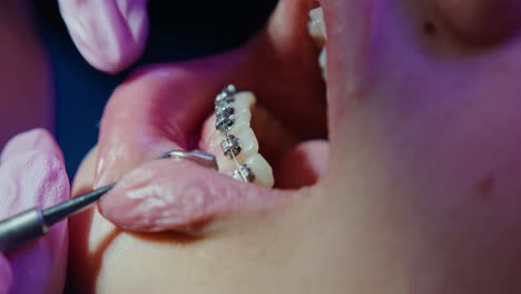 orthodontist-dentist-securing-Self-ligating-braces,-close-up