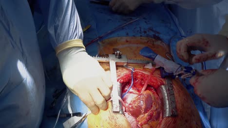 Das-Medizinische-Personal-Der-Operationseinheit-Bereitet-Die-Herzchirurgie-Auf-Die-Installation-Des-Shunts-Vor