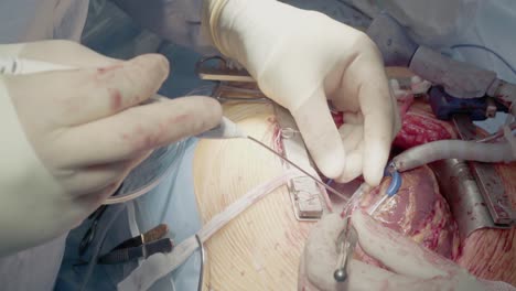 Das-Medizinische-Personal-Der-Operationseinheit-Führt-Die-Shunt-Installation-Für-Herzoperationen-Durch