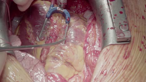El-Cirujano-Está-Instalando-Una-Derivación-En-El-Miocardio-2.