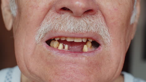 Zahnloser-Männlicher-Lächelnmund-Eines-älteren-Alten-Mannes,-Zahnproblem,-Schlechter,-Fauler-Zahnverlust,-Karies