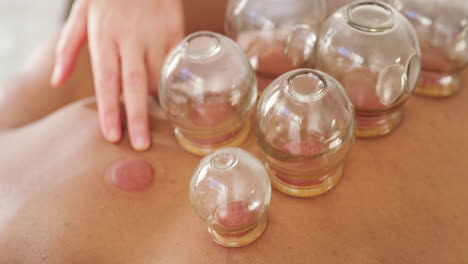 Therapist-using-cupping-therapy-to-treat-patient