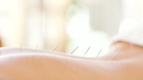 Closeup-of-back-with-acupuncture-needles