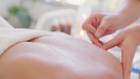 Closeup-of-acupuncture-needles-in-a-patient's