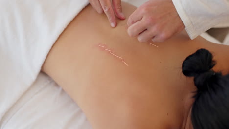 Acupuncture,-luxury-spa-and-massage-body-therapy