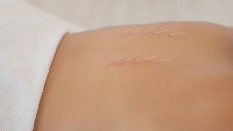Acupuncture,-asian-spa-and-wellness-massage-help