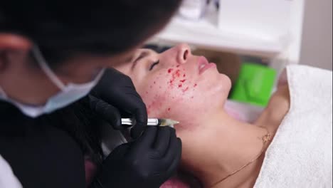Anti-aging-procedure:-professional-cosmetologist-makes-multiple-injections-in-woman's-face-skin-during-mesotherapy