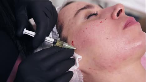 Professional-cosmetologist-makes-multiple-injections-in-woman's-face-skin-during-mesotherapy.-Biorevitalization-and-face-lifting